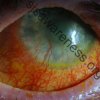 Left Eye - 24 year old male who suffered Toxic Epidermal Necrolysis Syndrome with severe Ocular involvement. Photo was taken 2 years after the initial TEN reaction